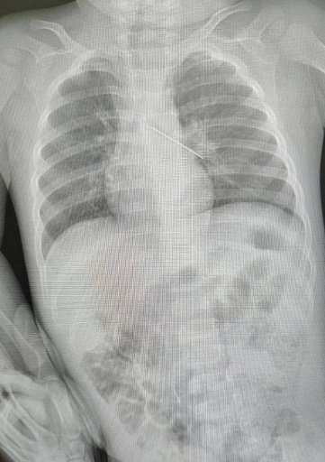 Врачи Сургута спасли малыша, вытащив из бронхов проглоченную булавку