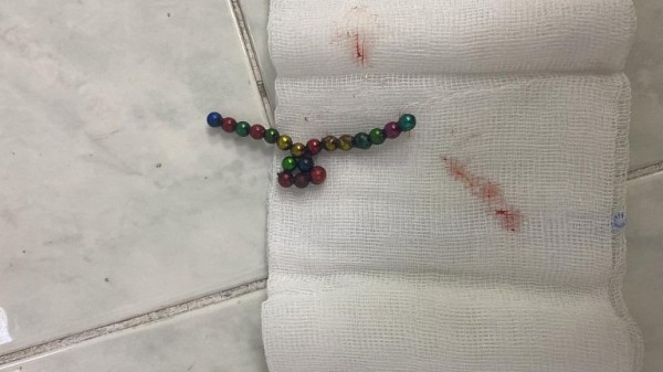 В Сургуте спасли малыша с кишечником, порванным из-за проглоченных магнитов В Сургуте спасли малыша с кишечником, порванным из-за проглоченных магнитов