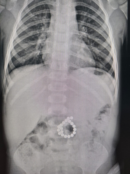 Врачи Сургута спасли малыша, проглотившего 19 магнитов Врачи Сургута спасли малыша, проглотившего 19 магнитов