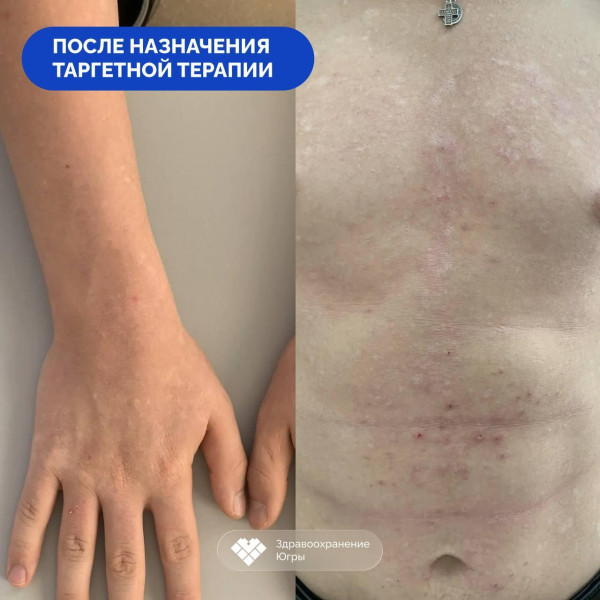 В Сургуте врачи выявили у подростка редчайшее иммунное заболевание