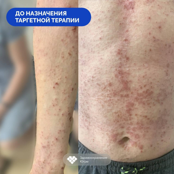 В Сургуте врачи выявили у подростка редчайшее иммунное заболевание