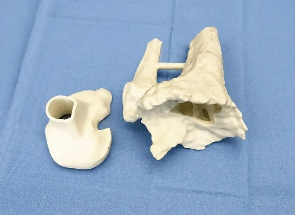 Врачи Сургута впервые установили пациентке напечатанную на 3D-принтере большеберцовую кость